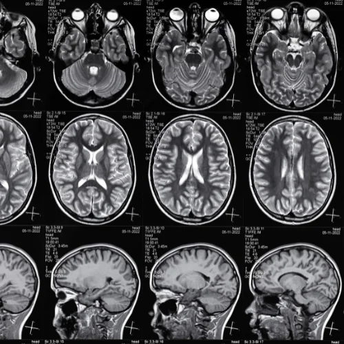 Brain MRI at Ayucare Diagnostic Center