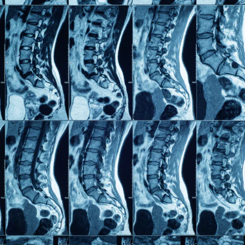 Spine MRI at Ayucare Diagnostic Center